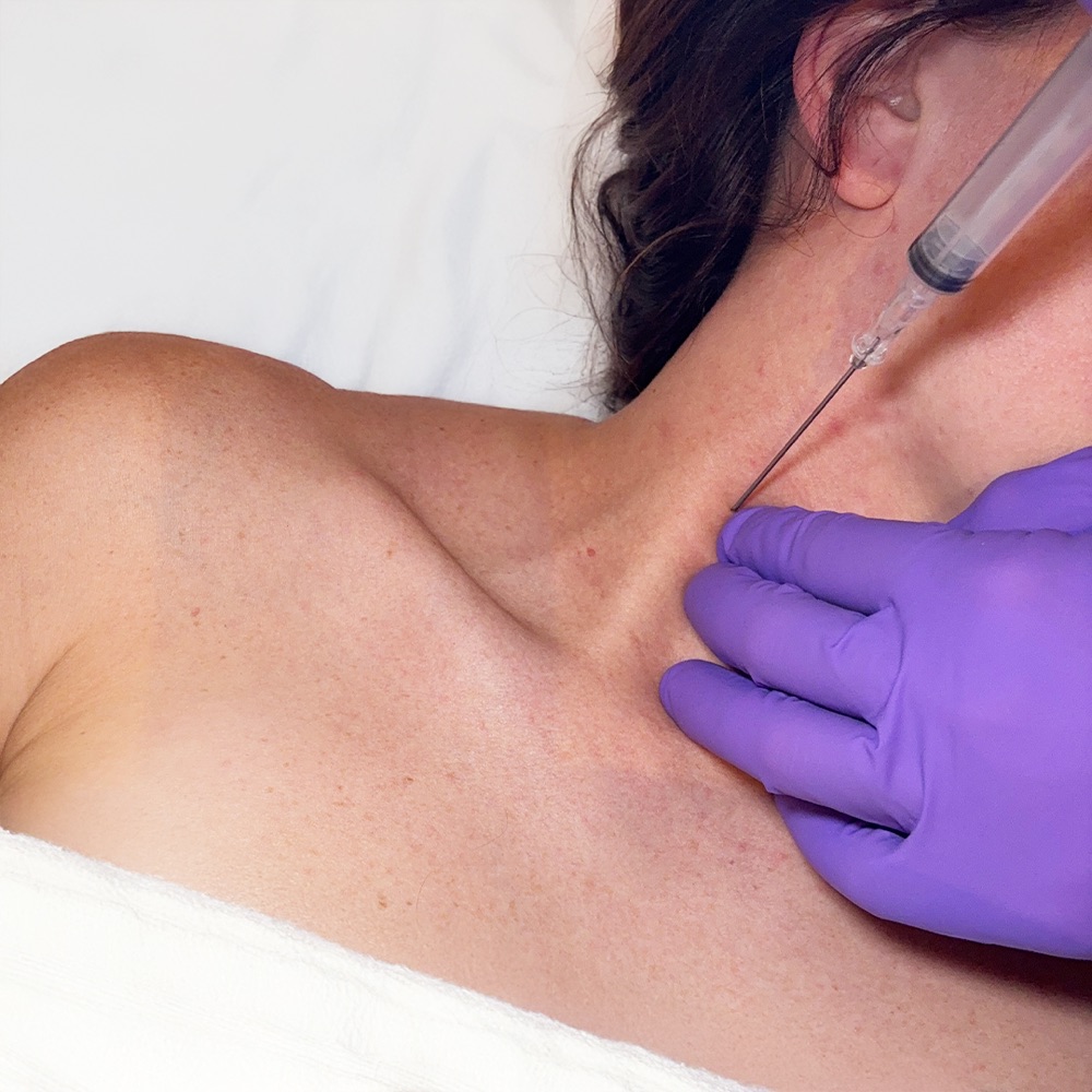 Photo of the internal jugular insertion landmark on the neck