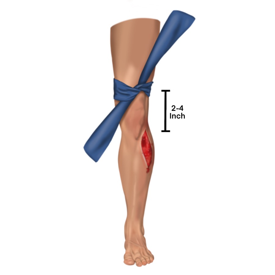 Hand-drawn illustration of a tourniquet placed above a leg wound